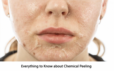 Everything to Know about Chemical Peeling
