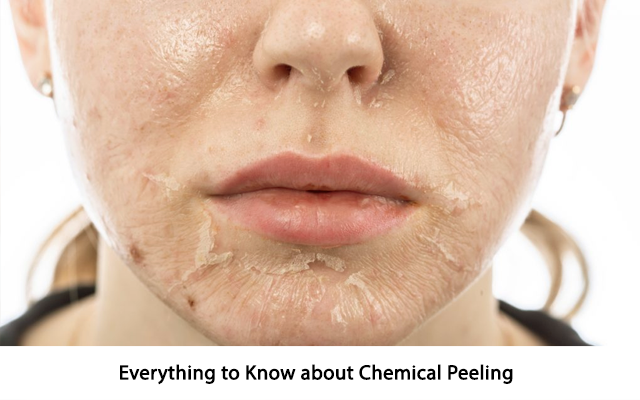 Everything to Know about Chemical Peeling