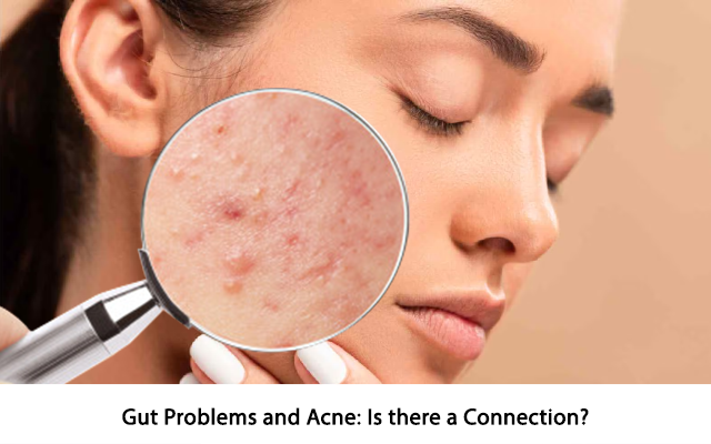 Gut Problems and Acne: Is there a Connection?