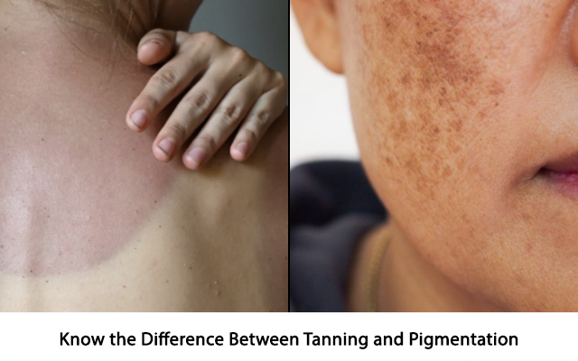 Know the Difference Between Tanning and Pigmentation