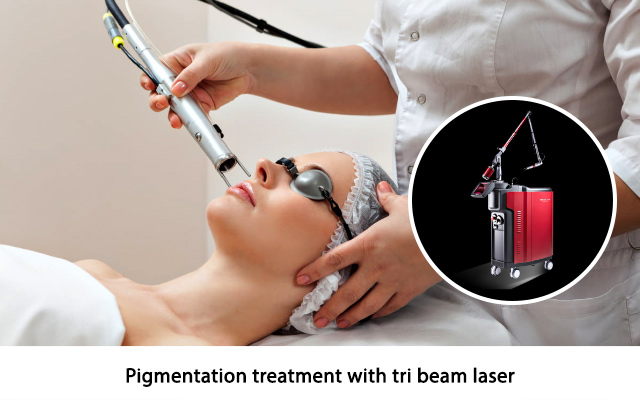 Pigmentation treatment with tri beam laser
