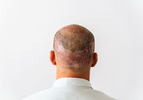 hair transplant