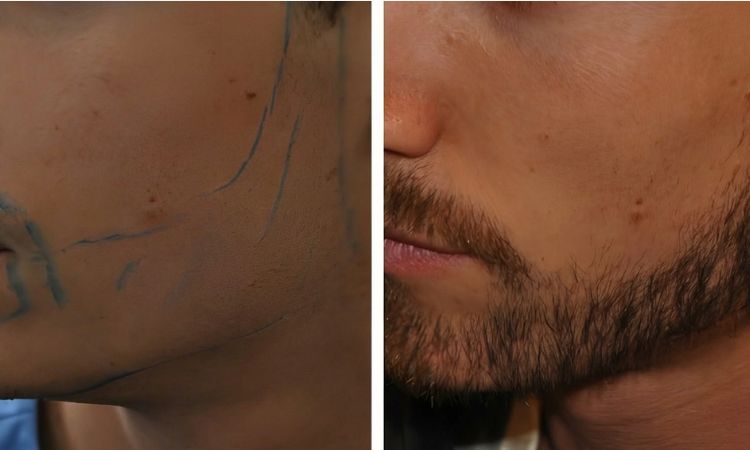Beard transplant result