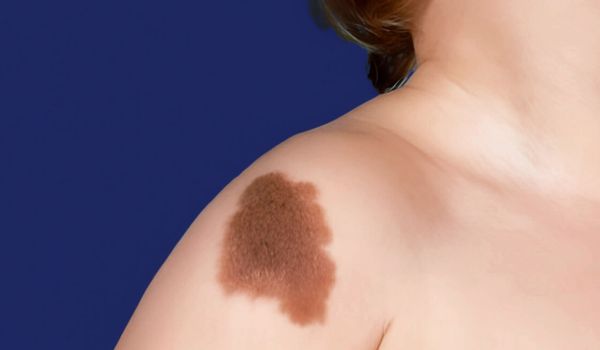 who needs the treatment