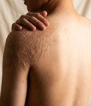 who needs the treatment