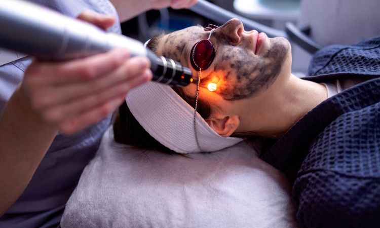 Carbon Laser Facial