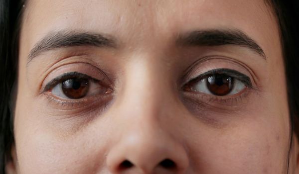 who needs the treatment