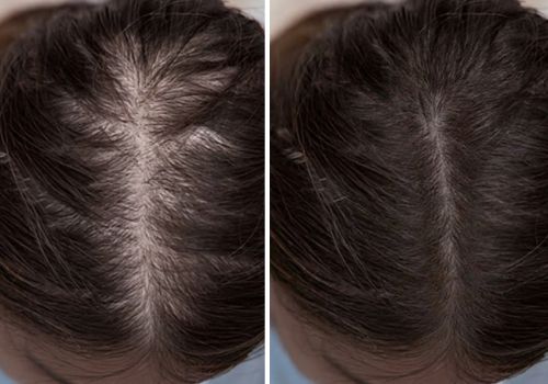 GFC treatment before after