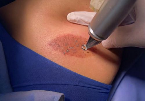 Laser on Birthmark