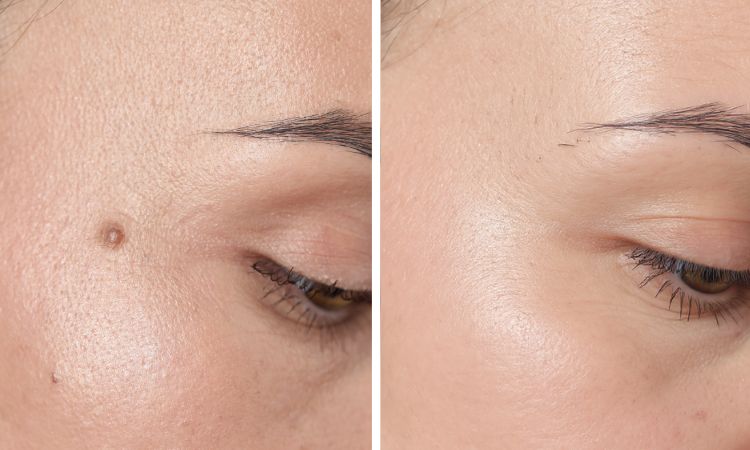 Mole Removal Transformation