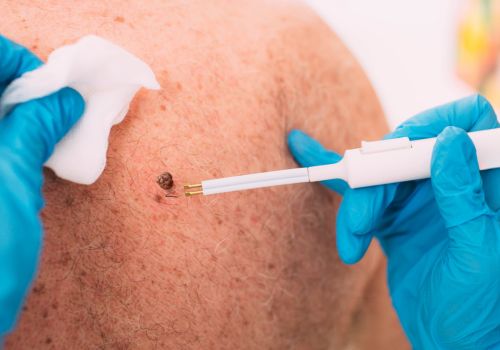 Mole Removal Treatment