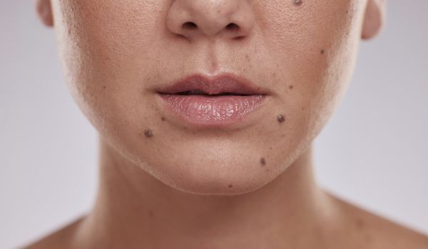 who needs the treatment