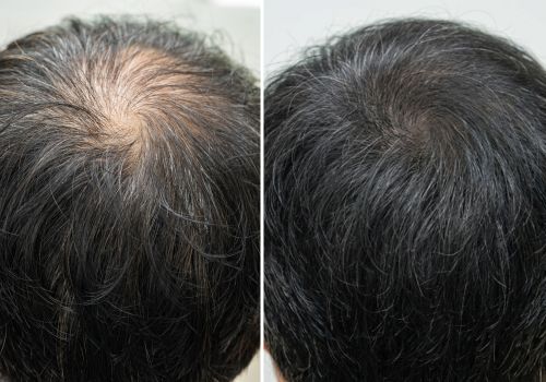 hair transplant