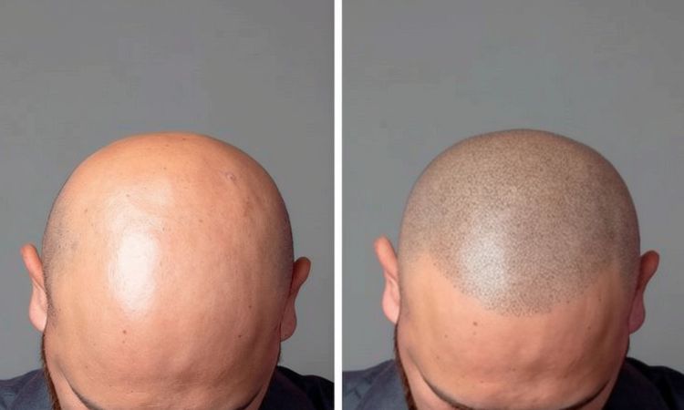 Scalp Micropigmentation