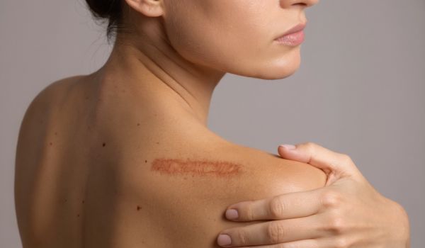 who needs the treatment