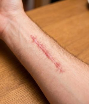 who needs the treatment