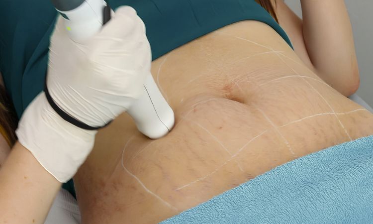 Stretch Marks Removal