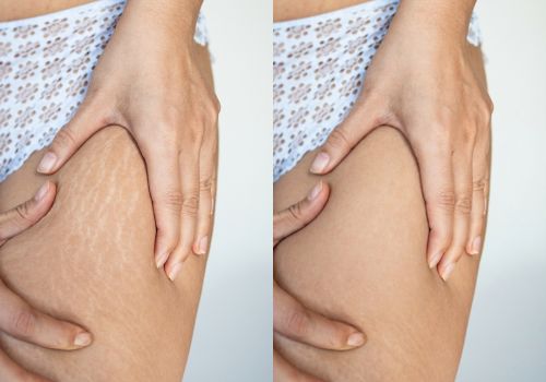 Stretch Marks Treatment
