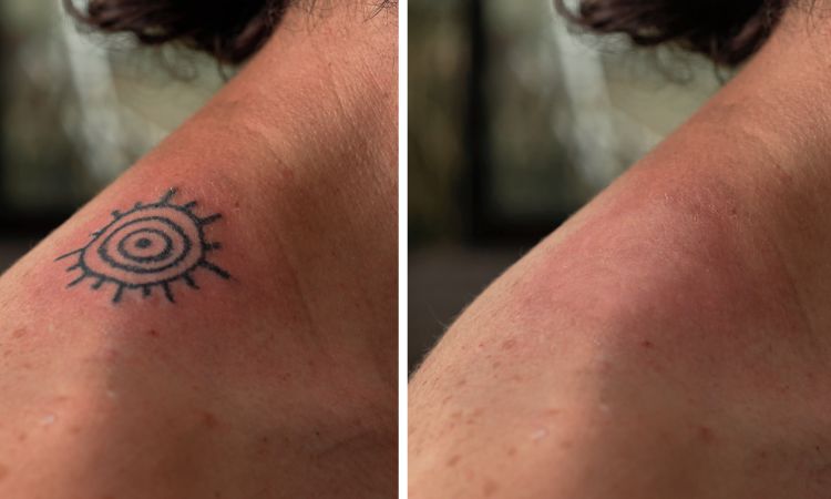 Tattoo Removal