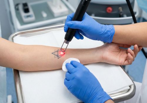 Tattoo Removal with Laser