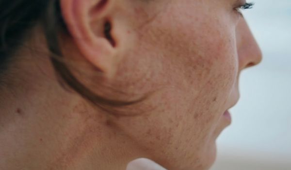 who needs the treatment