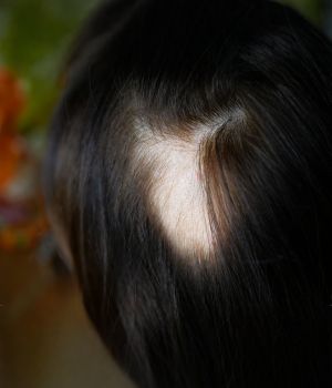 who needs the treatment