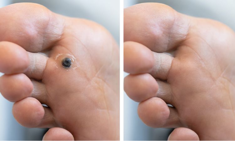 Wart Before-After