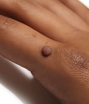 who needs the treatment