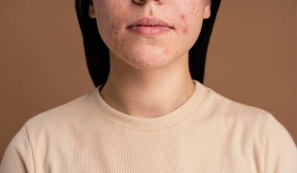 who needs the treatment