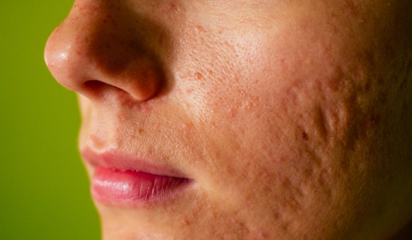 who needs the treatment