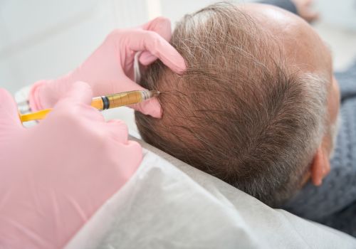 exosome hair treatment men