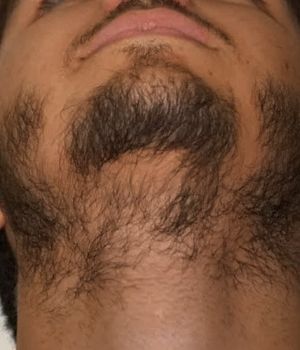 who needs the treatment