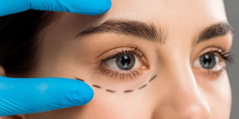 Blepharoplasty | Elation Skin & Hair