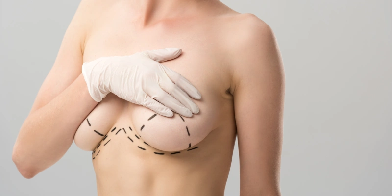 Breast Lift | Elation Skin & Hair