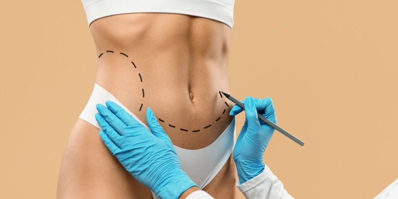 Liposuction | Elation Skin & Hair